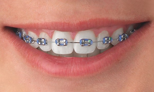 Plan de ortodoncia todo incluido en Family Dental